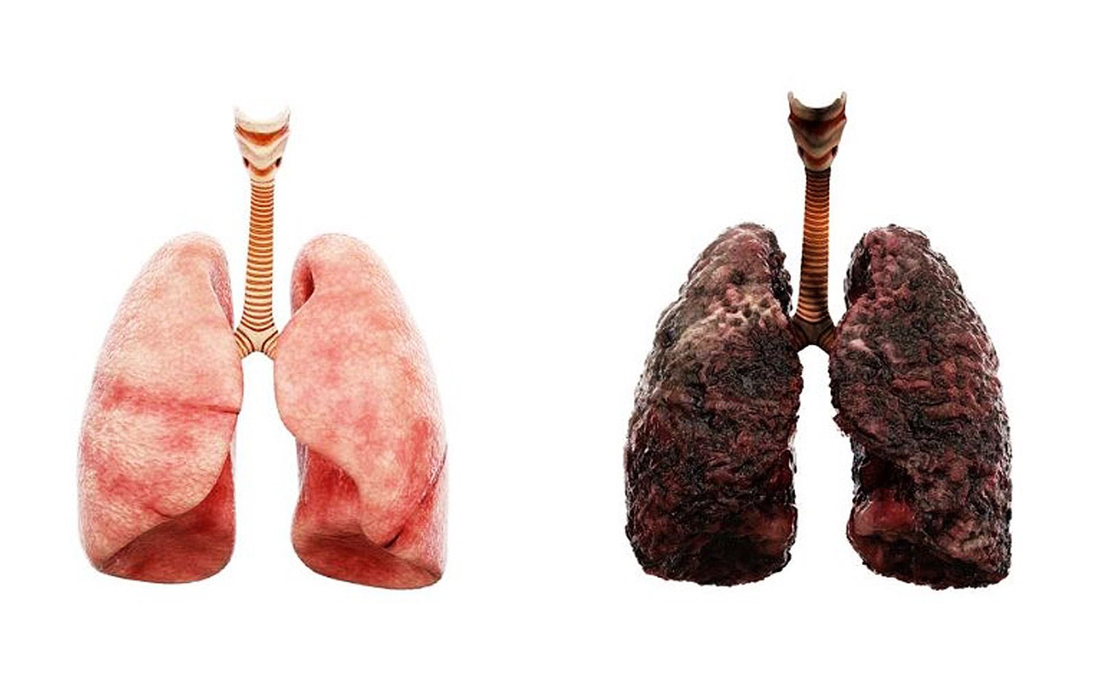 Smokers Lungs Vs Non Smokers