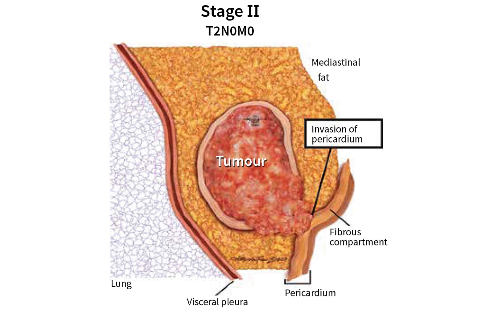 Highlights of the 8th Edition of the TNM Staging System: Practicalities and Tools