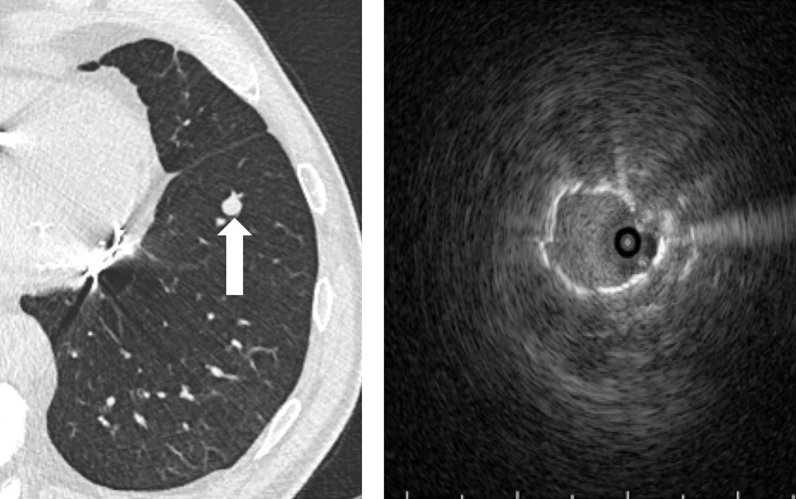 The Vital and Evolving Role of Bronchoscopic Technologies in Lung Cancer Management