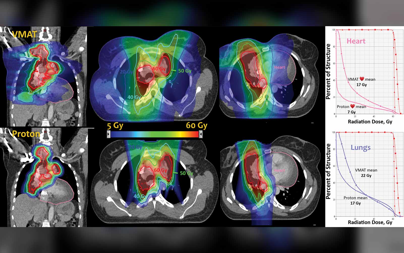 Living in the “Gray Zone”: Entering a New Age in Radiation Therapy for Patients with Lung
            Cancer