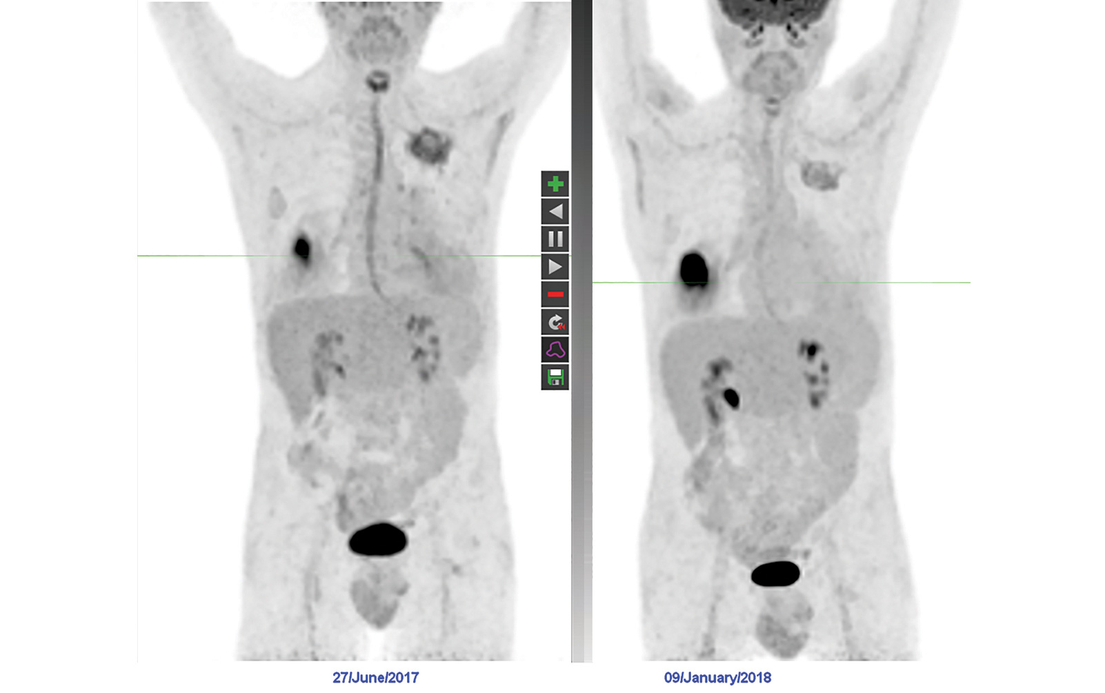 Nuances of PET Interpretation in Thoracic Oncology: More Than Just Lung Cancer