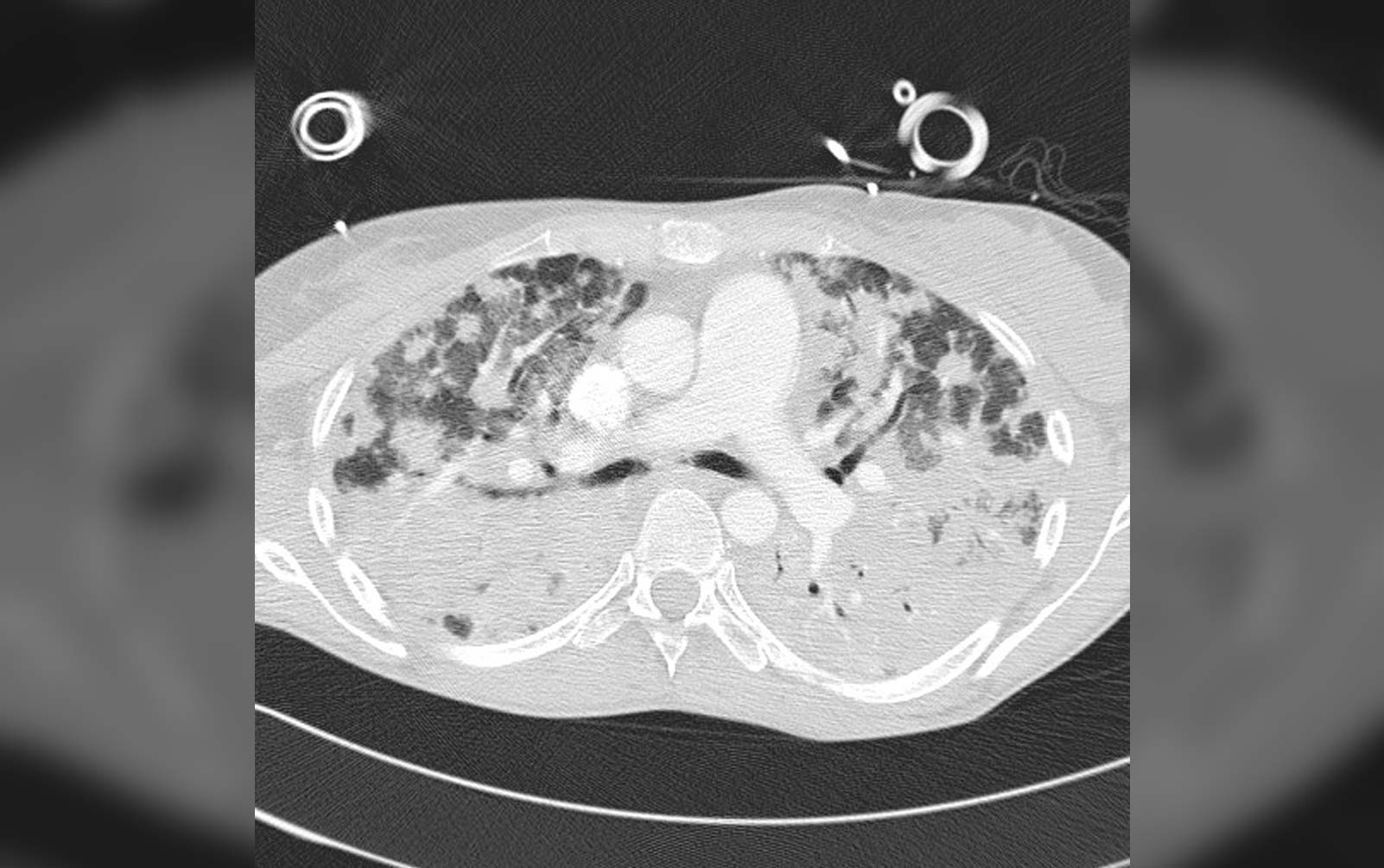 ICU Care for the Patient with Lung Cancer