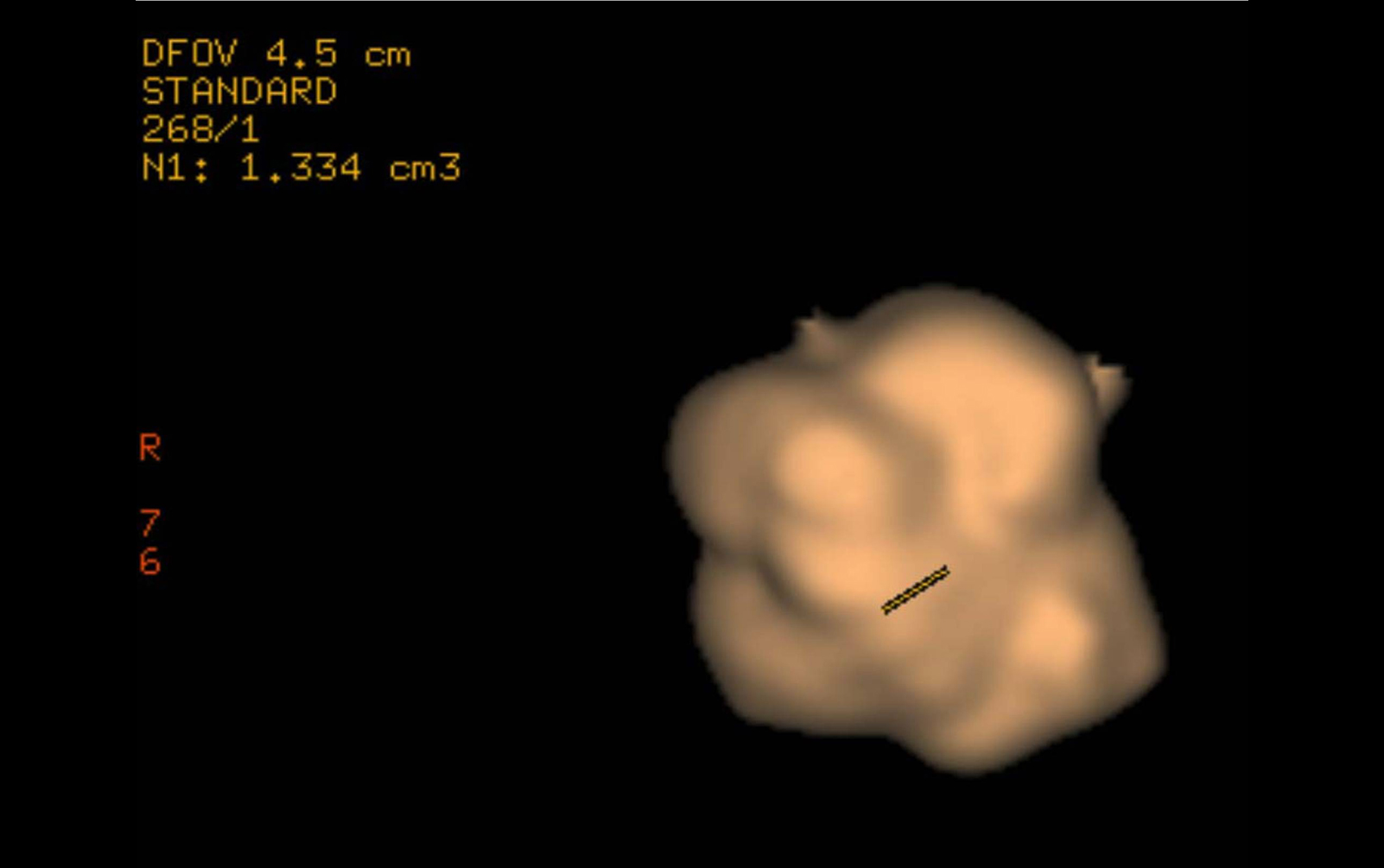 A Practical Approach to the Evaluation of Pulmonary Nodules