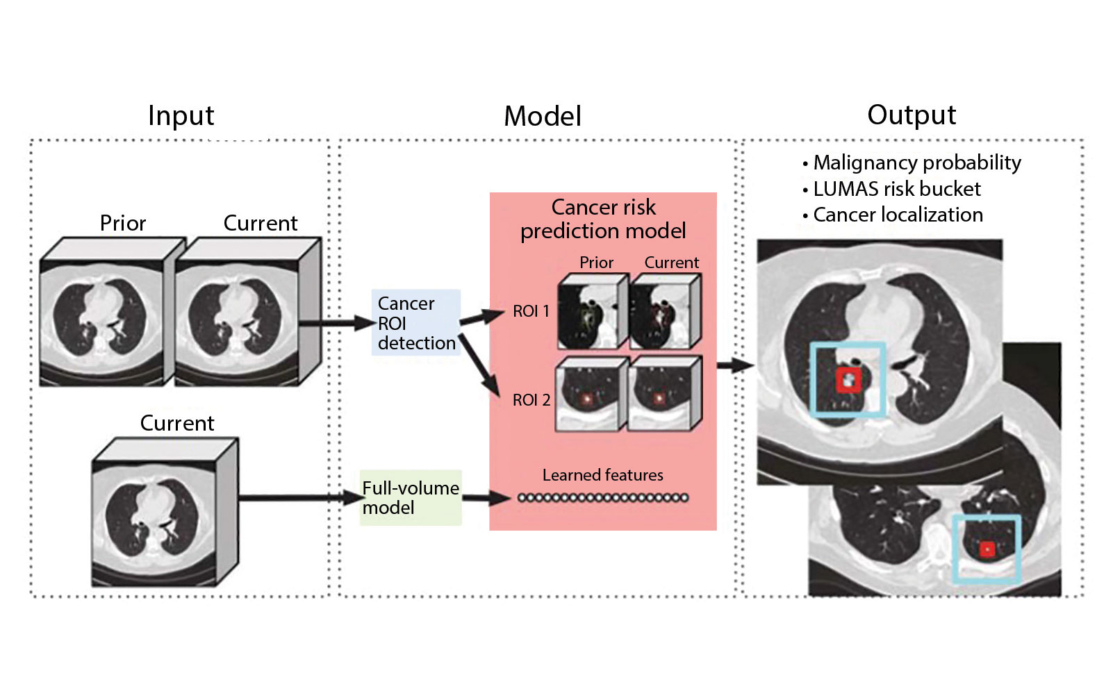 Artificial Intelligence in Lung Cancer: Opening New Avenues for Detection, Diagnosis, and
            Prognostication