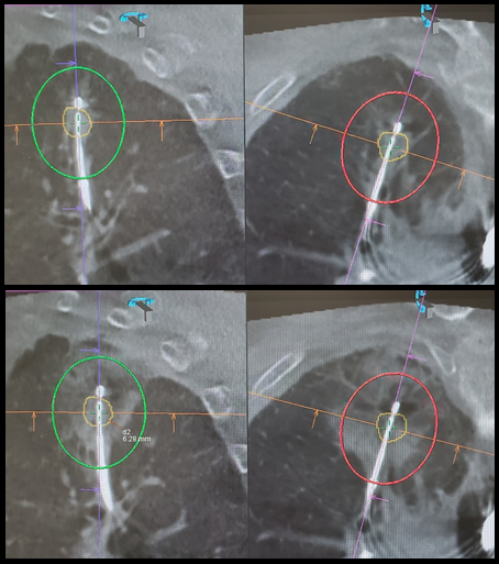 CT Scan of the lungs 