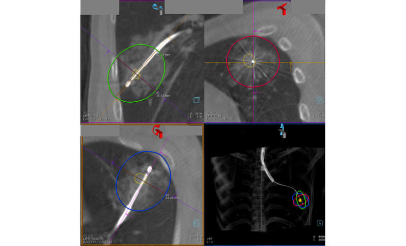 Fig. Transbronchial Microwave Ablation of Lung Cancer