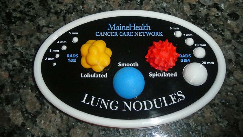 3D Model of Lung Nodules Reduces Anxiety for Patients While Helping Them Understand Their Cancer Risk