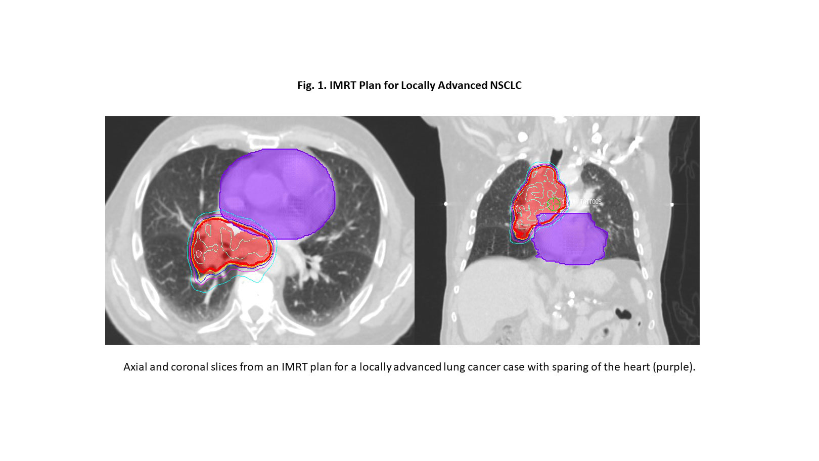 Cardiac Radiation Dose, Cardiac Events, and Survival in Locally Advanced NSCLC