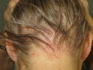 sebopsoriasis of the scalp 