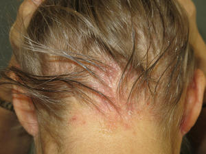 sebopsoriasis of the scalp