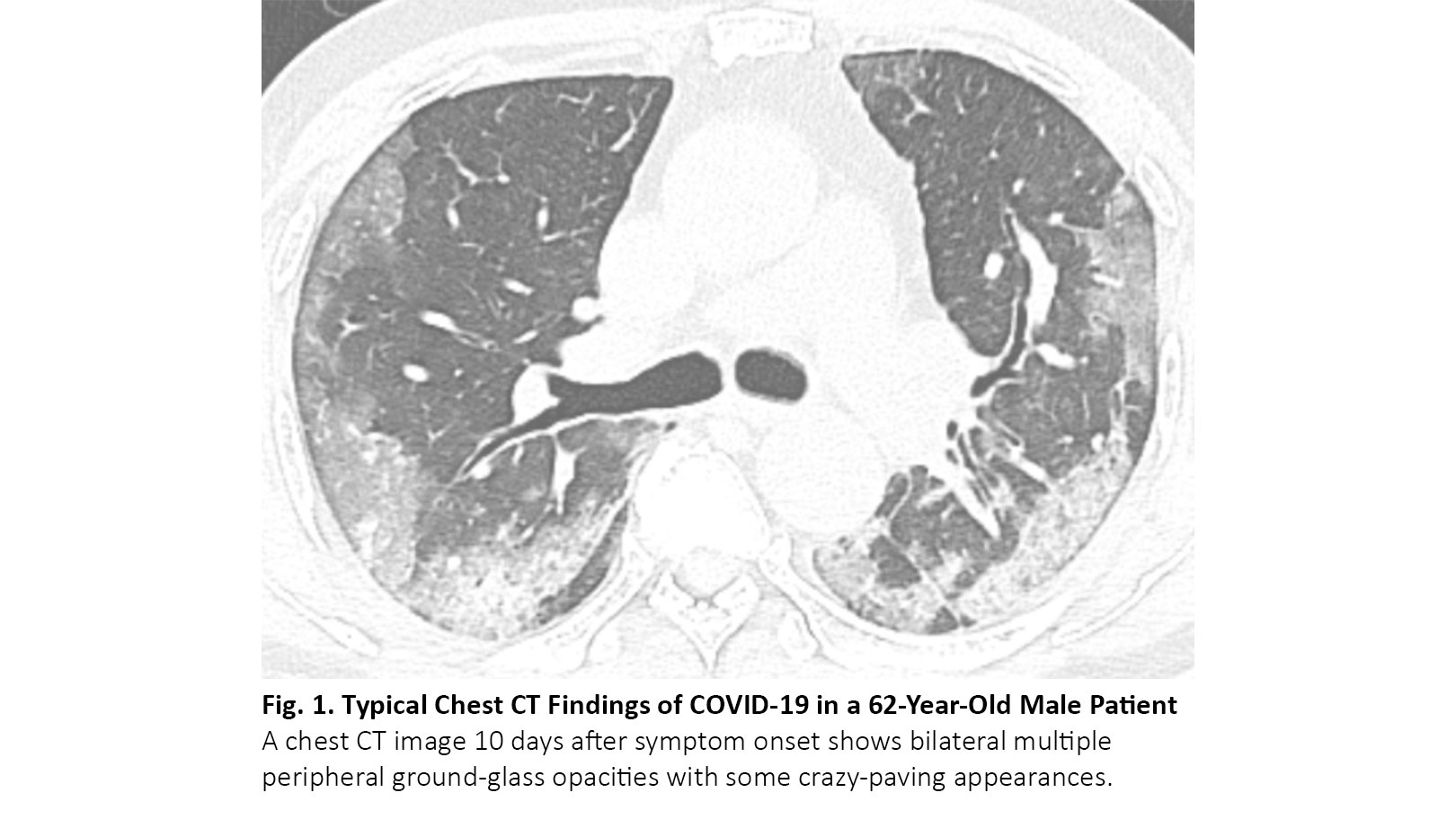 CT Findings of COVID-19 Pneumonia and Mimicking Diseases in Patients With Lung Cancer