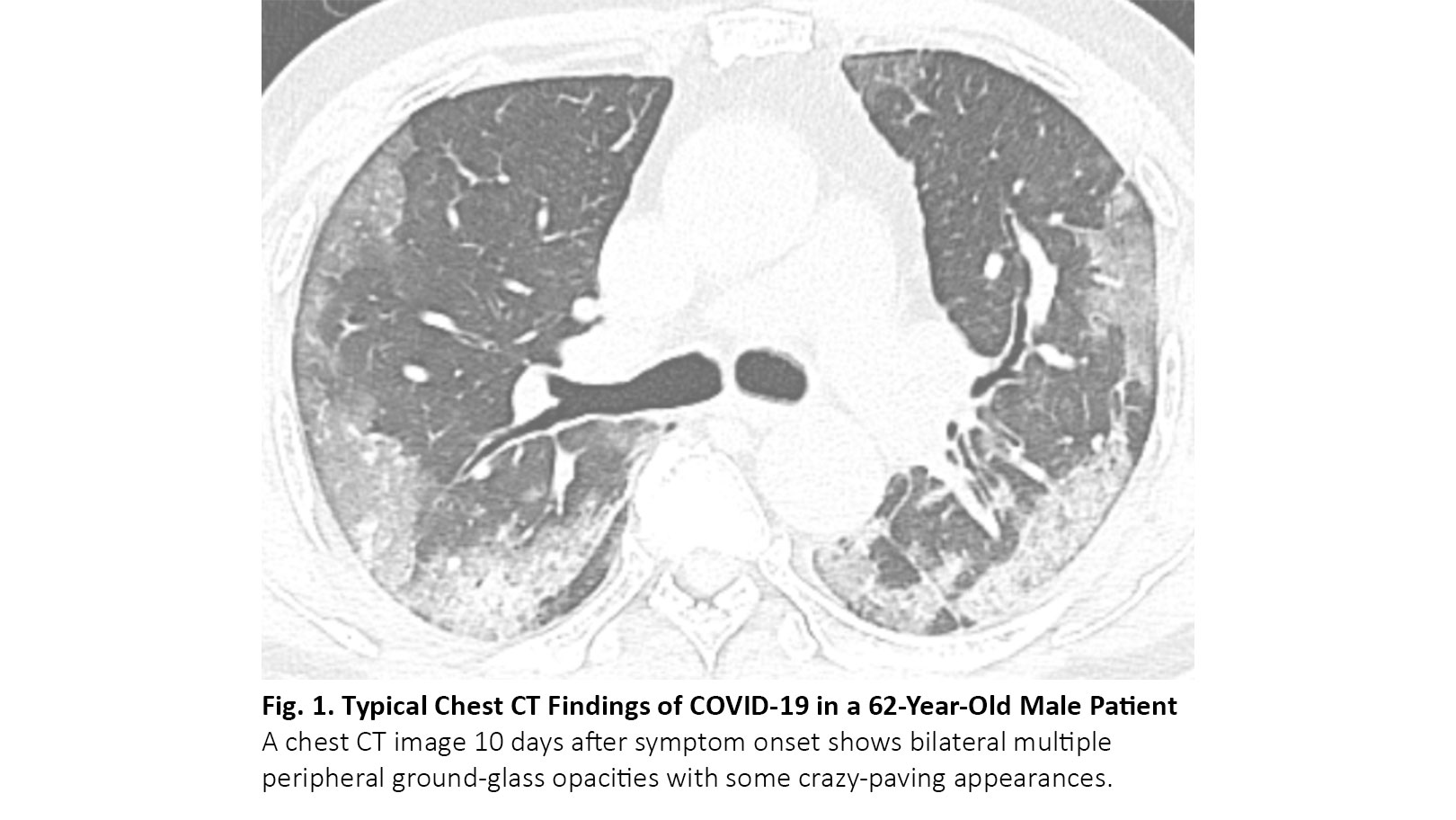 Findings of COVID-19 Pneumonia and Mimicking Diseases in With Lung Cancer - ILCN.org (ILCN/WCLC)