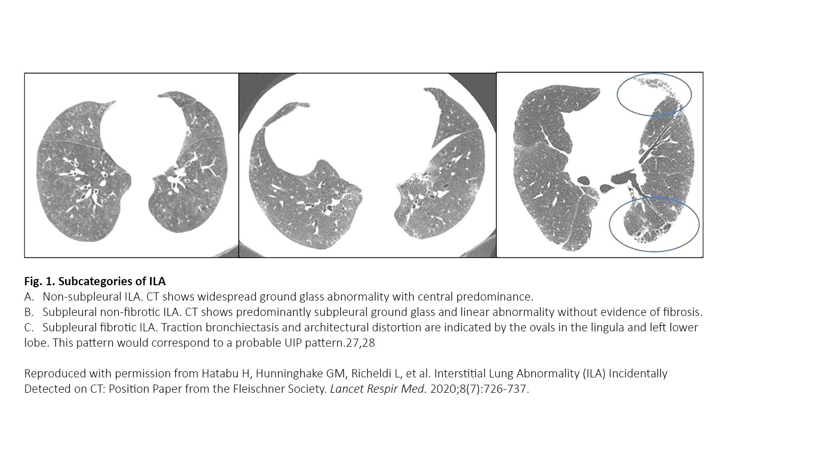 Interstitial Lung Abnormality, Interstitial Lung Disease, and Lung Cancer