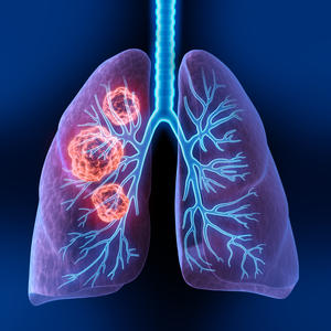 Lungs with tumors 