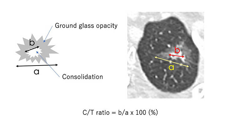 Mitsudomi.Resections.figs-2