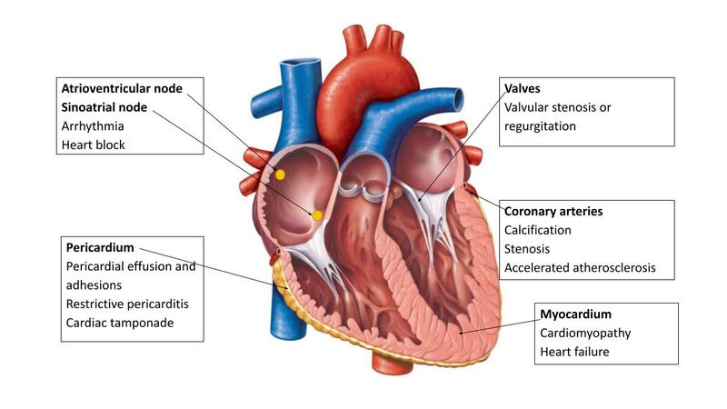 Figure. Potential Radiotherapy-Induced Complications, by Cardiac Substructure