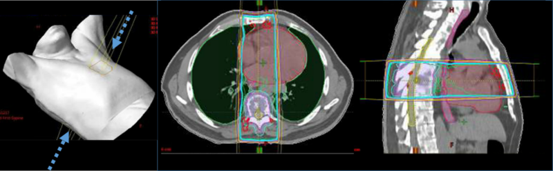 Beam arrangement and corresponding isodose distribution for a patient treated with 3D conformal radiotherapy for thoracic spine metastasis. 