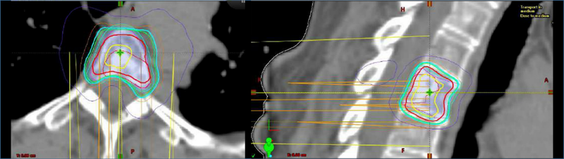 Axial and sagittal treatment-planning CT scan with corresponding isodose distribution for a stereotactic radiosurgery treatment for an isolated thoracic spine metastasis. 
