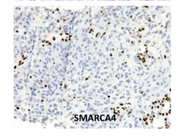 The New WHO Classification of Lung Tumors