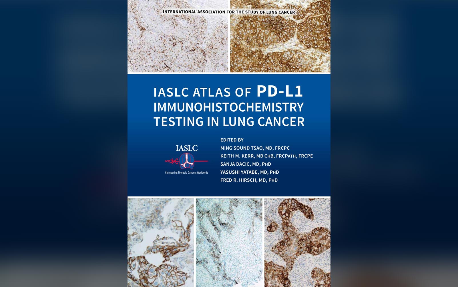 IASLC Atlas of PD-L1 Immunohistochemistry Testing in Lung Cancer