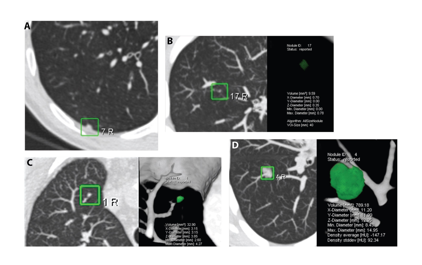 Implementation of Lung Cancer CT Screening: A Global Dream or a Real Possibility?