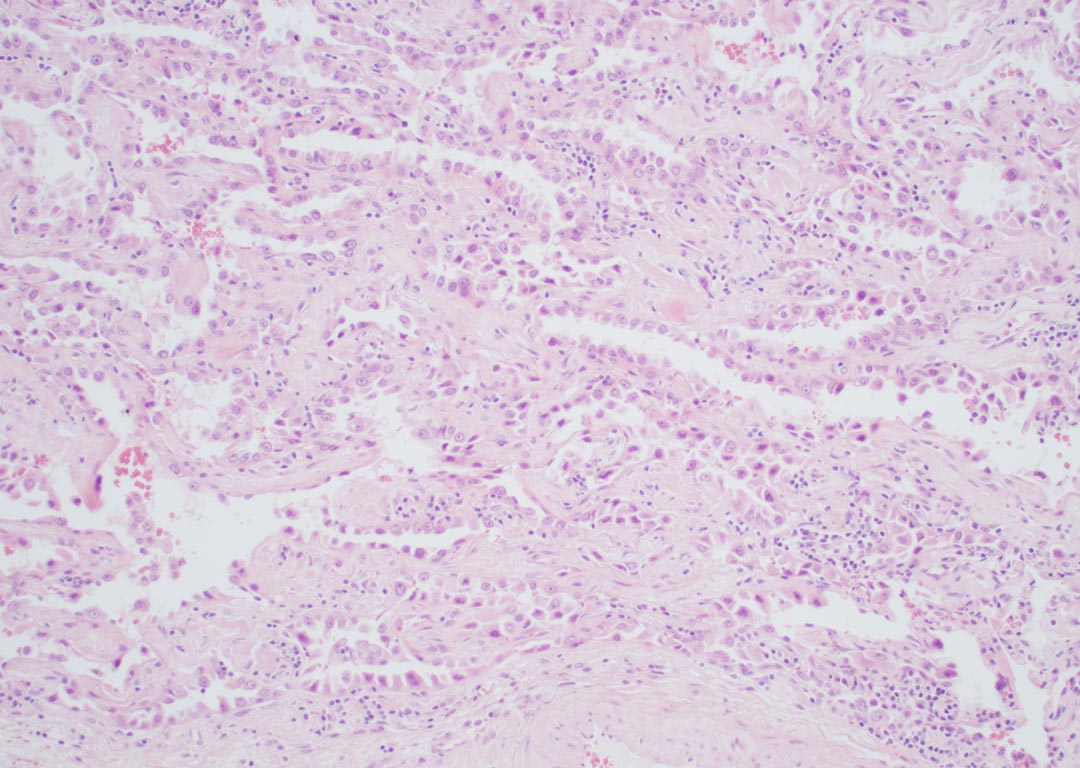 Fig. 1: Example of an adenocarcinoma in which opinions may vary