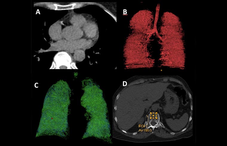 Lung Cancer Screening in Brazil: Recent Efforts, Challenges, and Opportunities