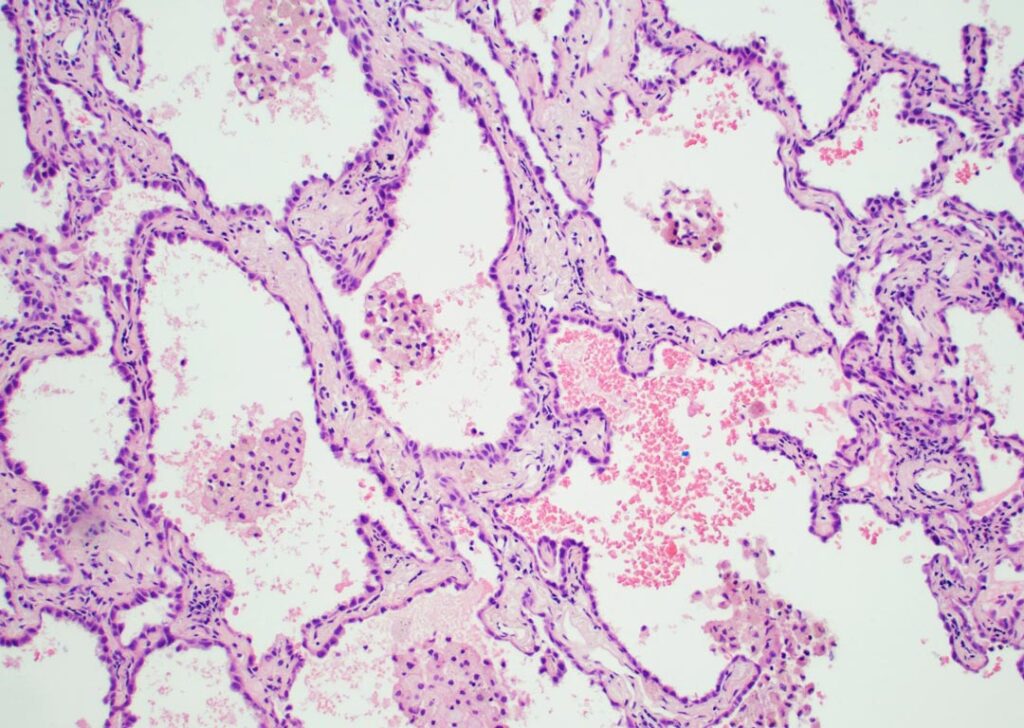 Fig. 1. Lepidic growth characterized by preserved alveolar architecture and a monolayer of tumor cells lining pre-existing alveolar walls. H&E stain at 100x magnification.