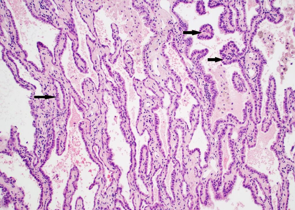 Fig. 2. Lepidic growth with early compression. In this example, lung architecture is compressed but still preserved and characterized by a parallel configuration; tumor cells are arranged in a monolayer. Compression may lead to a false impression of acinar or papillary growth (see arrows). H&E stain at 100x magnification.