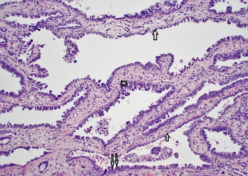 Fig. 3. Preserved alveolar architecture with tumor cells showing lepidic growth as a single layer (single arrow), areas of greater cytologic atypia and multiple cell layers corresponding to the proposed histology of extensive epithelial proliferation (double arrows), and areas which might be classified as low papillary or micropapillary (asterisks). H&E stain at 100x magnification.